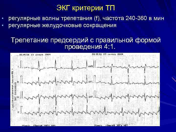 ЭКГ критерии ТП • регулярные волны трепетания (f), частота 240 -360 в мин •