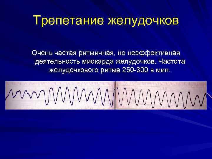 Трепетание желудочков Очень частая ритмичная, но неэффективная деятельность миокарда желудочков. Частота желудочкового ритма 250