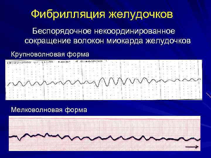 Фибрилляция желудочков Беспорядочное некоординированное сокращение волокон миокарда желудочков Крупноволновая форма Мелковолновая форма 