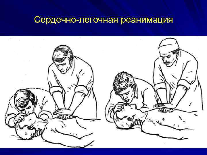 Сердечно-легочная реанимация 