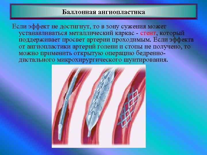 Ангиопластика сосудов нижних. Баллонная коронарная ангиопластика. ТРАНСЛЮМИНАЛЬНАЯ баллонная ангиопластика. Баллонная ангиопластика верхних конечностей. Баллонная ангиопластика ПБА что это.