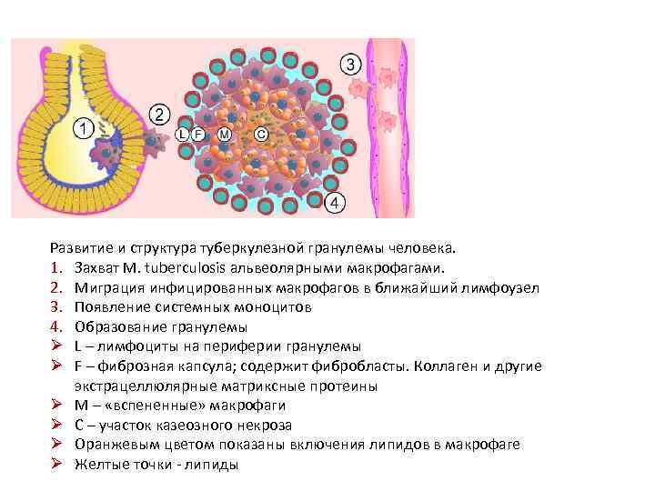 Развитие и структура туберкулезной гранулемы человека. 1. Захват M. tuberculosis альвеолярными макрофагами. 2. Миграция