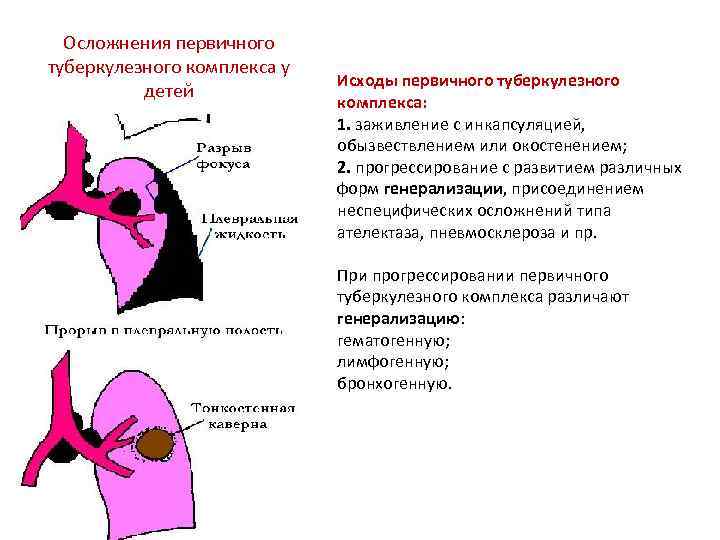 Осложнения первичного туберкулезного комплекса у детей Исходы первичного туберкулезного комплекса: 1. заживление с инкапсуляцией,