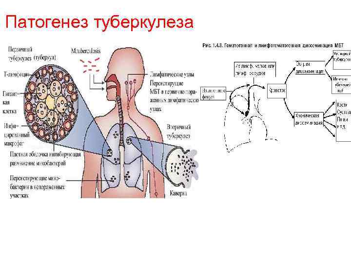 Патогенез туберкулеза 