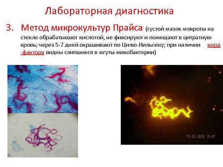  Лабораторная диагностика 3. Метод микрокультур Прайса (густой мазок мокроты на стекле обрабатывают кислотой,