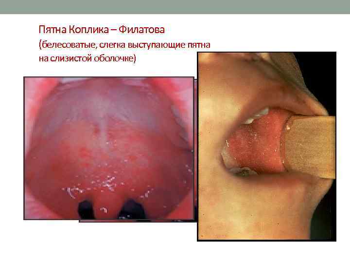 Пятна Коплика – Филатова (белесоватые, слегка выступающие пятна на слизистой оболочке) 