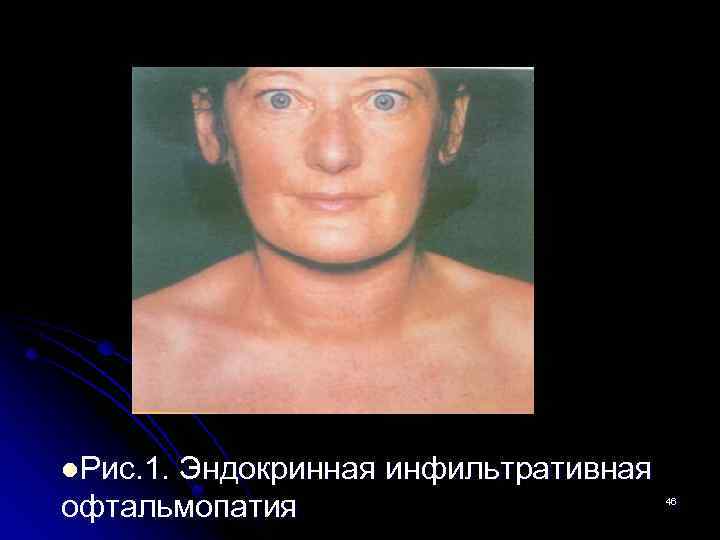 l. Рис. 1. Эндокринная инфильтративная офтальмопатия 46 