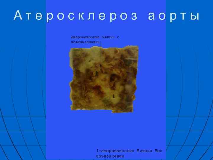 Атеросклероз аорты 