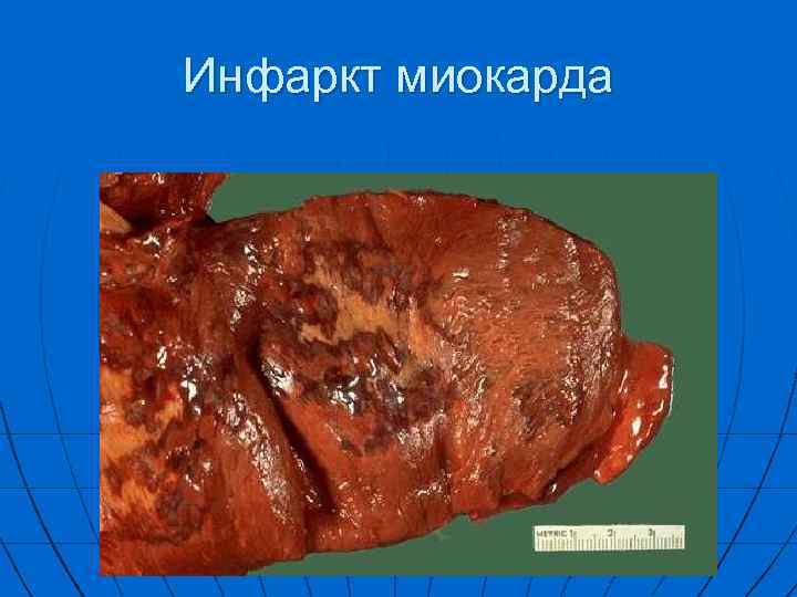 Инфаркт миокарда 