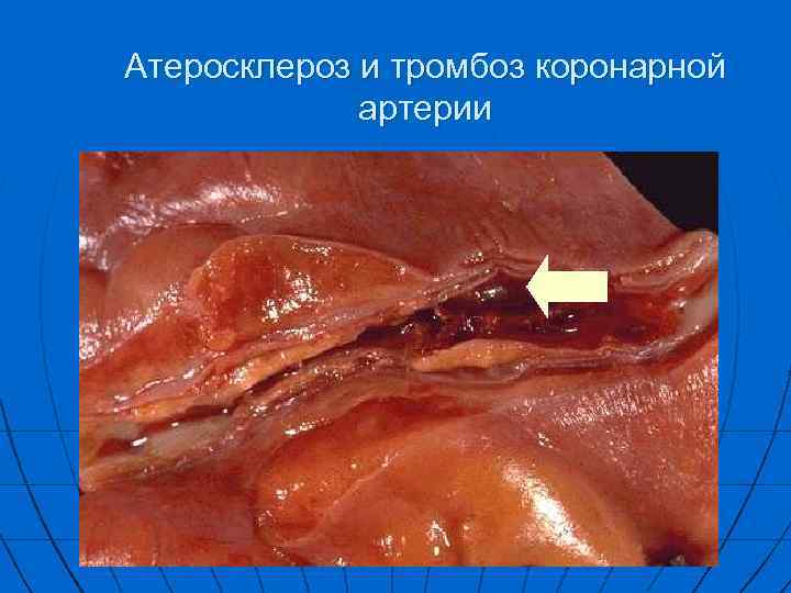 Атеросклероз и тромбоз коронарной артерии 