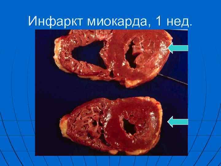 Инфаркт миокарда, 1 нед. 