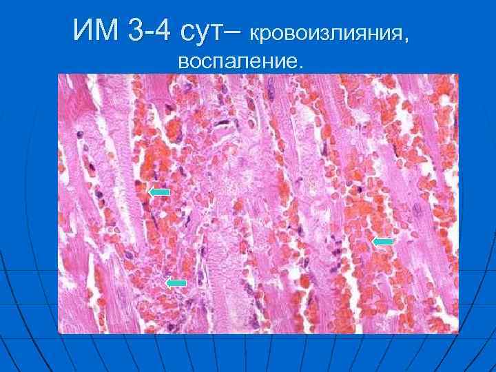 ИM 3 -4 сут– кровоизлияния, воспаление. 