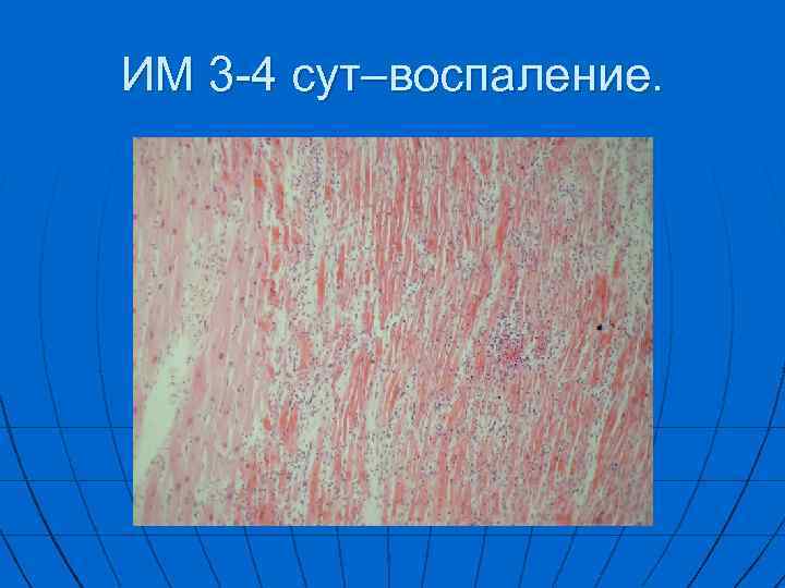 ИM 3 -4 сут–воспаление. 