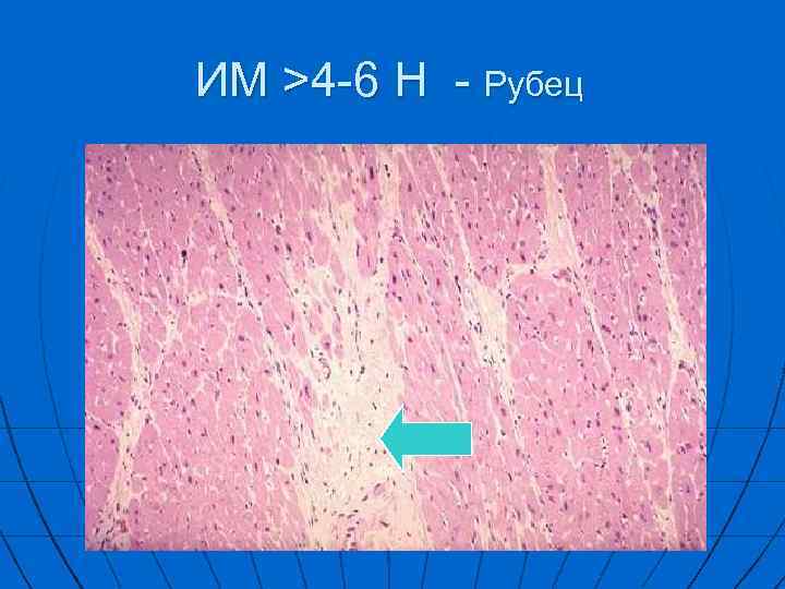 ИM >4 -6 Н - Рубец 
