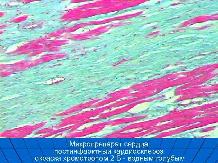 Микропрепарат сердца: постинфарктный кардиосклероз, окраска хромотропом 2 Б - водным голубым 