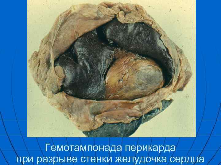 Гемотампонада перикарда при разрыве стенки желудочка сердца 