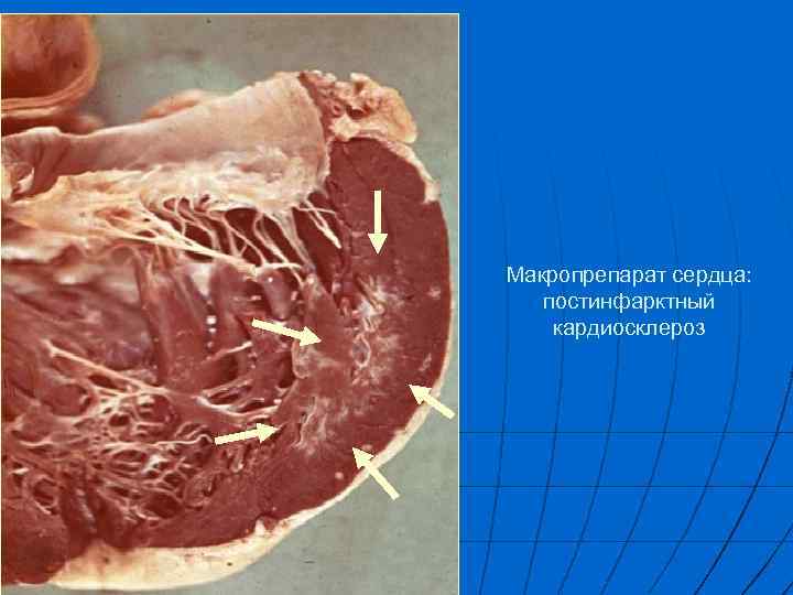 Макропрепарат сердца: постинфарктный кардиосклероз 
