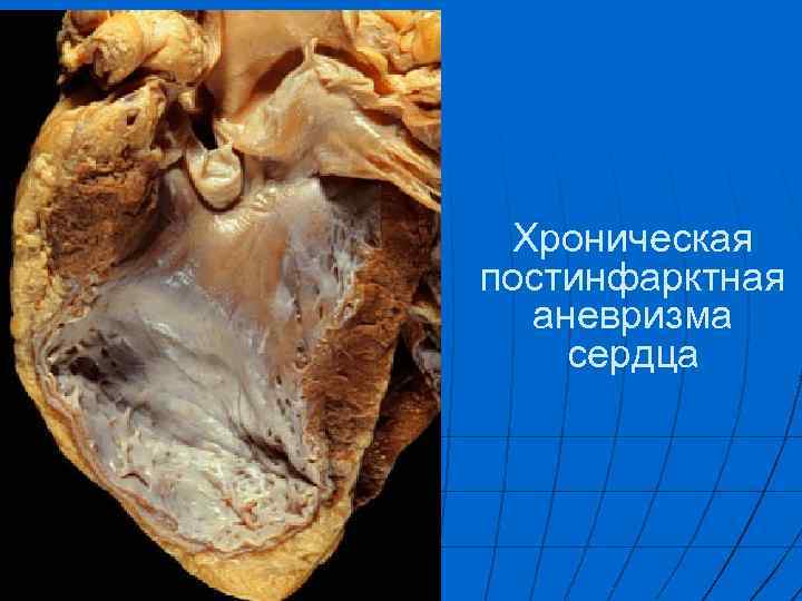 Хроническая постинфарктная аневризма сердца 