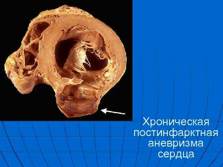 Хроническая постинфарктная аневризма сердца 