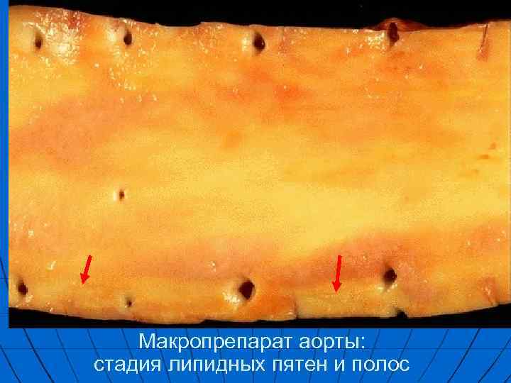 Макропрепарат аорты: стадия липидных пятен и полос 