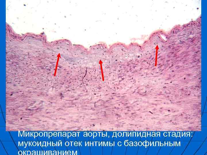 Микроскопическая картина атеросклероза аорты