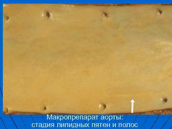 Макропрепарат аорты: стадия липидных пятен и полос 