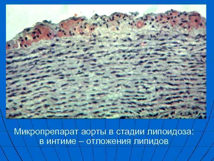 Микропрепарат аорты в стадии липоидоза: в интиме – отложения липидов 