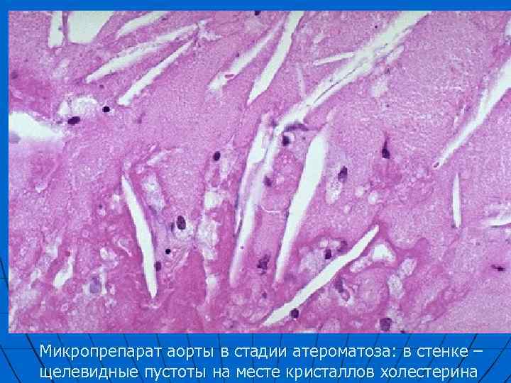 Микропрепарат аорты в стадии атероматоза: в стенке – щелевидные пустоты на месте кристаллов холестерина