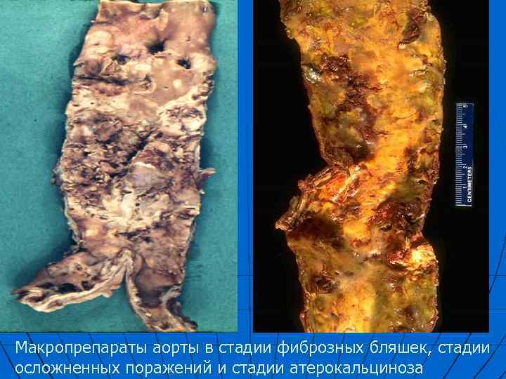 Макропрепараты аорты в стадии фиброзных бляшек, стадии осложненных поражений и стадии атерокальциноза 