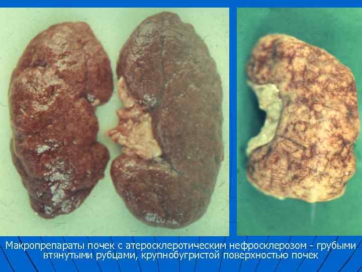 Макропрепараты почек с атеросклеротическим нефросклерозом - грубыми втянутыми рубцами, крупнобугристой поверхностью почек 