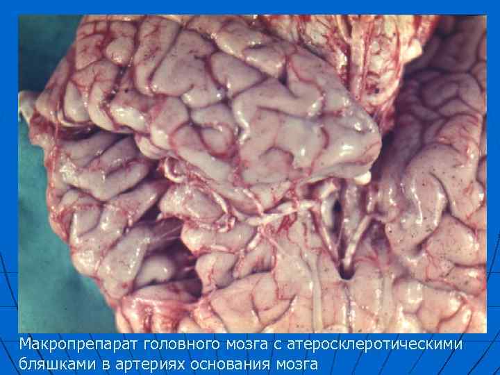 Макропрепарат головного мозга с атеросклеротическими бляшками в артериях основания мозга 