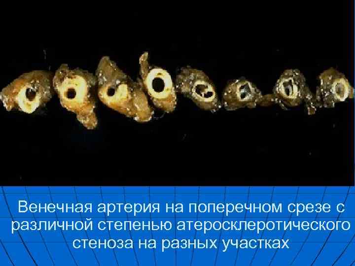 Венечная артерия на поперечном срезе с различной степенью атеросклеротического стеноза на разных участках 