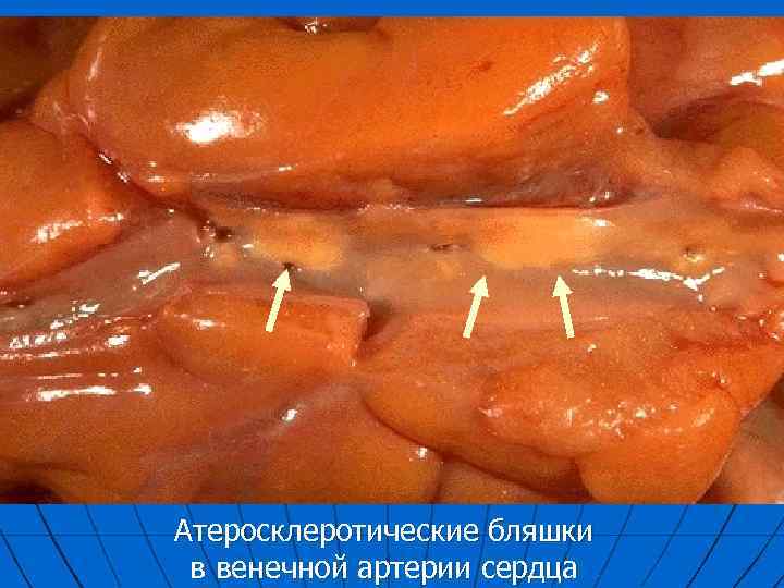 Атеросклеротические бляшки в венечной артерии сердца 