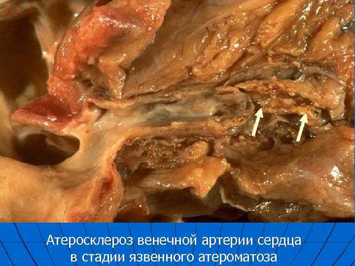 Атеросклероз венечной артерии сердца в стадии язвенного атероматоза 