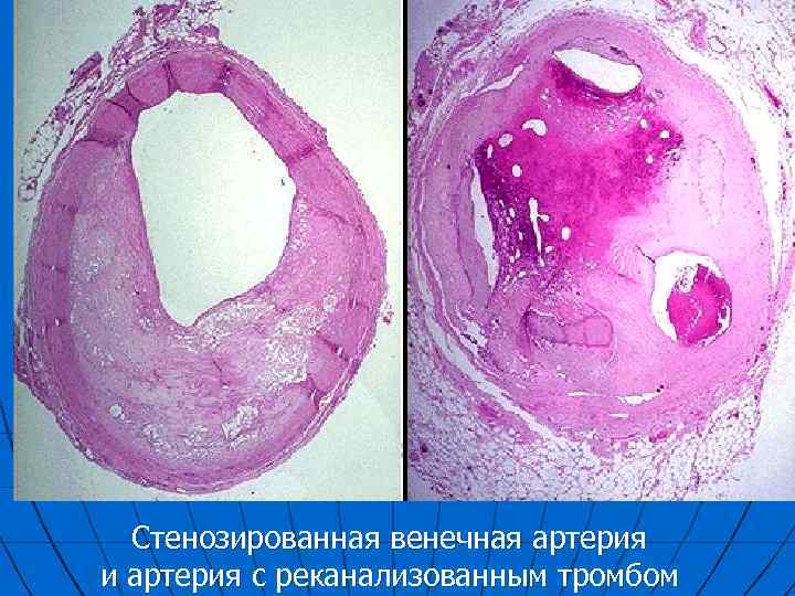 Стенозированная венечная артерия и артерия с реканализованным тромбом 