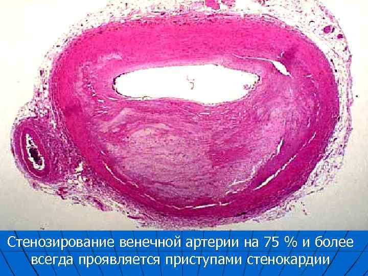 Стенозирование венечной артерии на 75 % и более всегда проявляется приступами стенокардии 