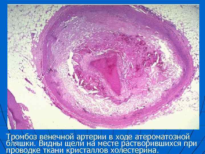 Тромбоз венечной артерии в ходе атероматозной бляшки. Видны щели на месте растворившихся при проводке