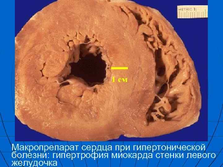 Макропрепарат сердца при гипертонической болезни: гипертрофия миокарда стенки левого желудочка 
