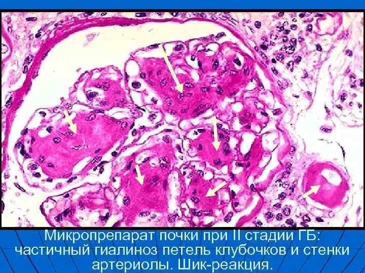 Микропрепарат почки при II стадии ГБ: частичный гиалиноз петель клубочков и стенки артериолы. Шик-реакция.