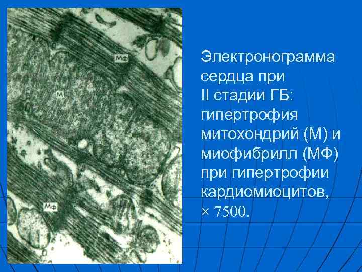 Электронограмма сердца при II стадии ГБ: гипертрофия митохондрий (М) и миофибрилл (МФ) при гипертрофии