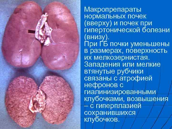 Макропрепараты нормальных почек (вверху) и почек при гипертонической болезни (внизу). При ГБ почки уменьшены