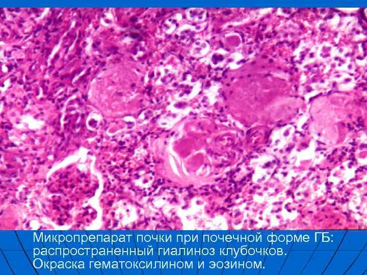 Микропрепарат почки при почечной форме ГБ: распространенный гиалиноз клубочков. Окраска гематоксилином и эозином. 