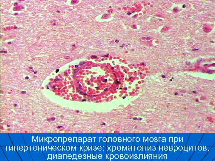 Микропрепарат головного мозга при гипертоническом кризе: хроматолиз невроцитов, диапедезные кровоизлияния 