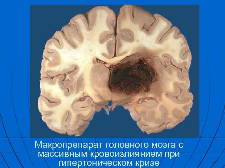 Макропрепарат головного мозга с массивным кровоизлиянием при гипертоническом кризе 