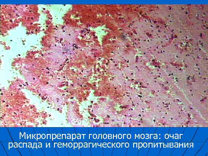 Микропрепарат головного мозга: очаг распада и геморрагического пропитывания 
