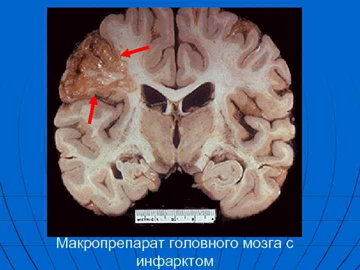 Макропрепарат головного мозга с инфарктом 