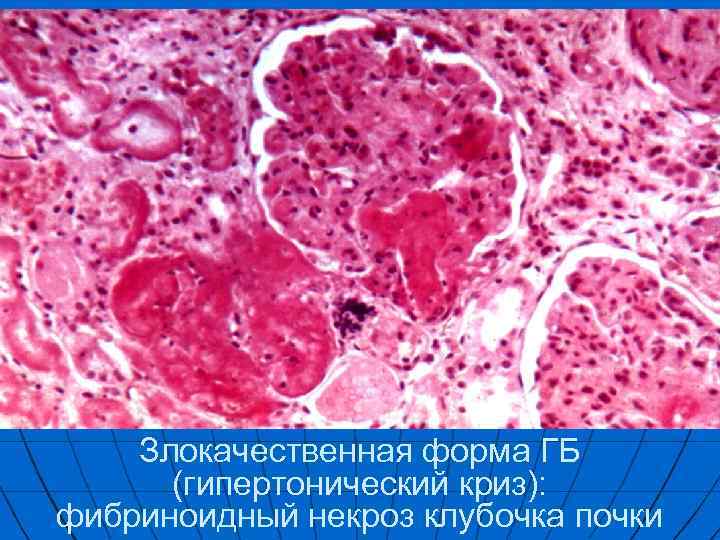 Злокачественная форма ГБ (гипертонический криз): фибриноидный некроз клубочка почки 