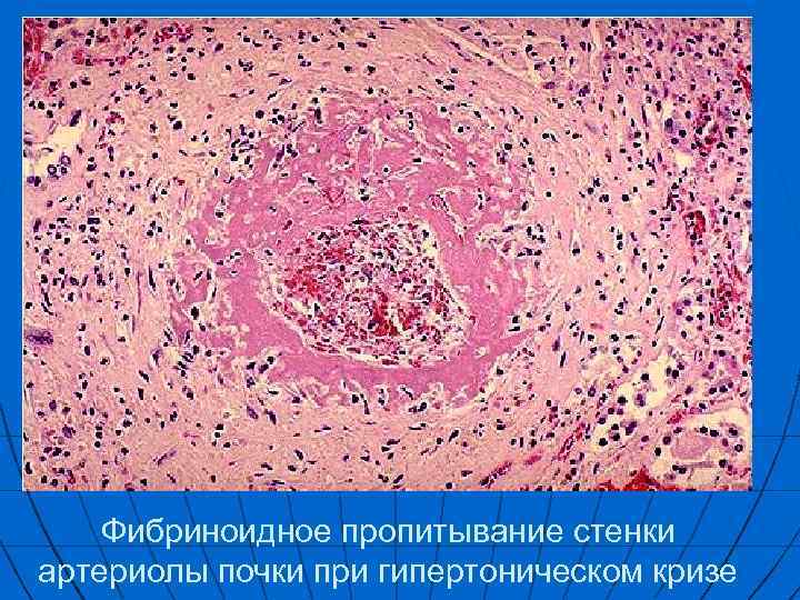 Фибриноидное пропитывание стенки артериолы почки при гипертоническом кризе 