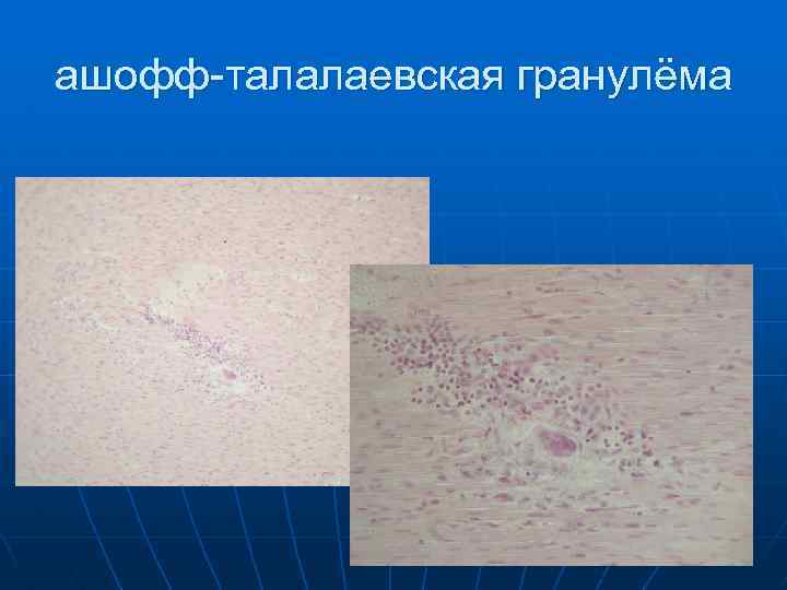 ашофф-талалаевская гранулёма 
