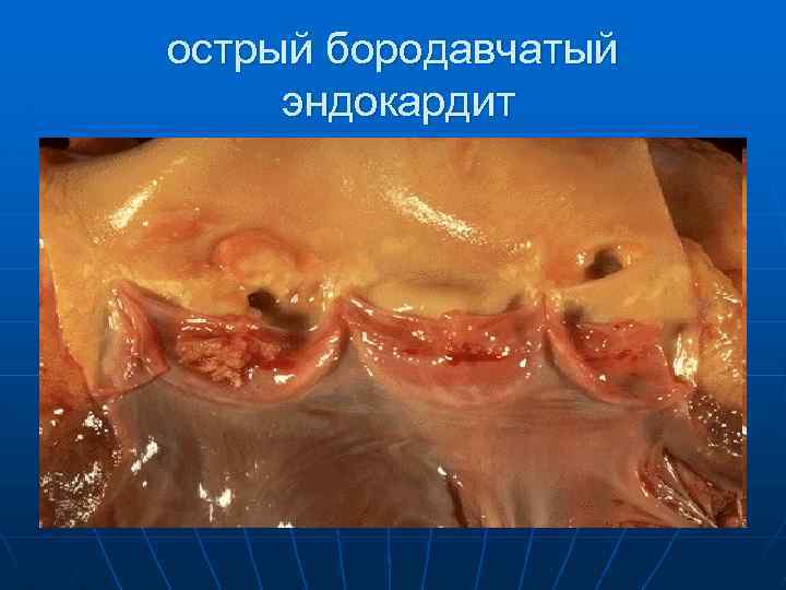 острый бородавчатый эндокардит 